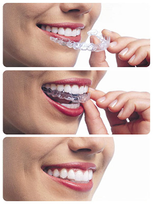 Sequential steps of a person putting an Invisalign tray in their mouth