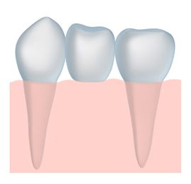 Illustration of a dental bridge