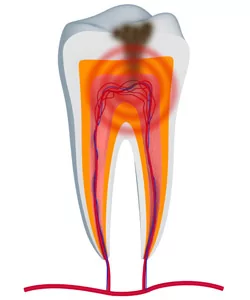 Illustrated image of infected tooth pulp